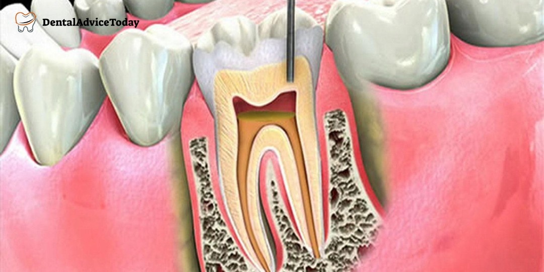 Root Canal Recovery Time