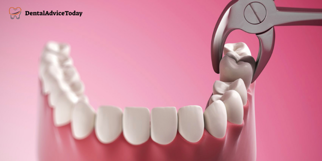 Root Canal or Tooth Extraction? How to Make the Right Choice