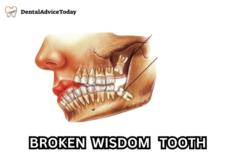 Broken Wisdom Tooth: What You Need to Know