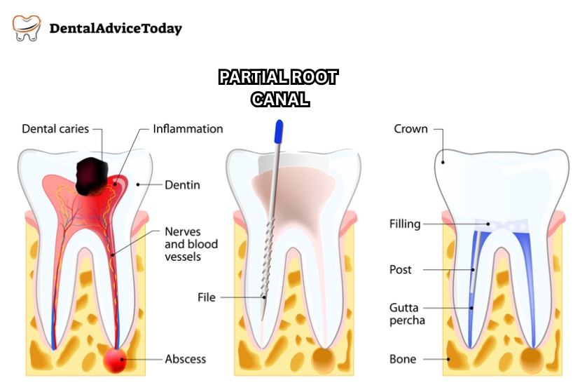 Partial Root Canal