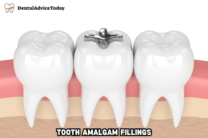 Tooth Amalgam Fillings: Dental Advice Today