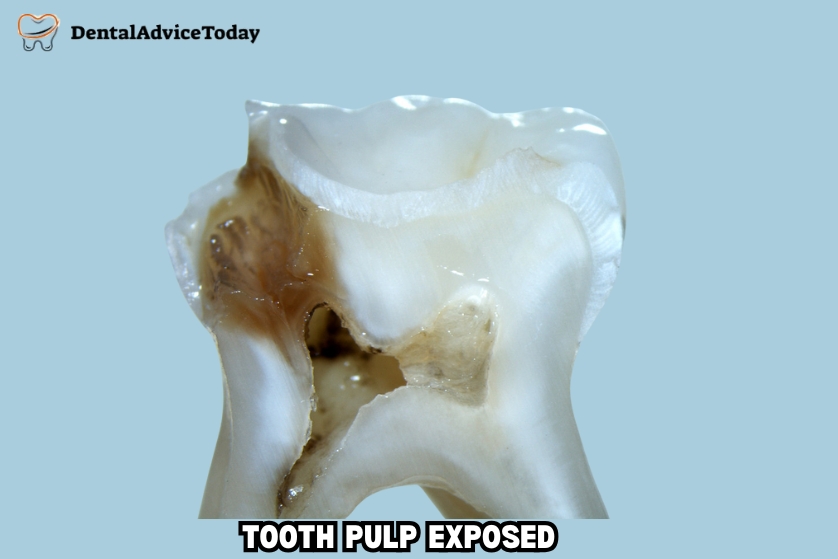 Tooth Pulp Exposed: Dental Advice Today
