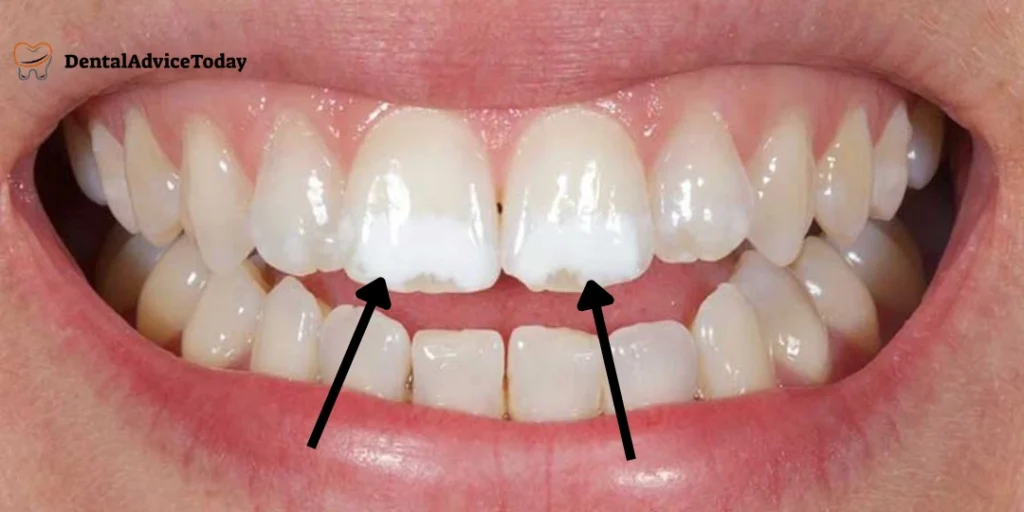 white spots on teeth