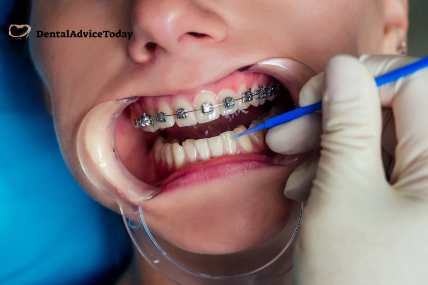 How Long do Braces Take to Straighten Teeth?