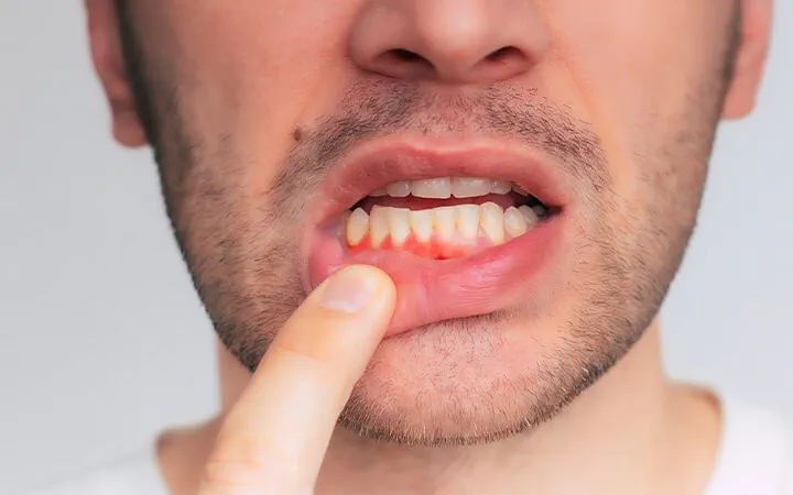 How to Cure Gum Disease Without a Dentist