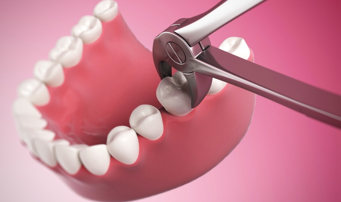 Teeth Extractions