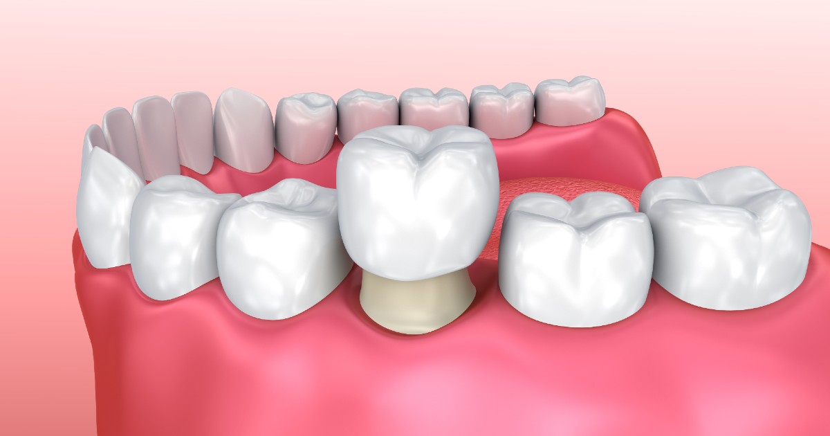 price of dental cap