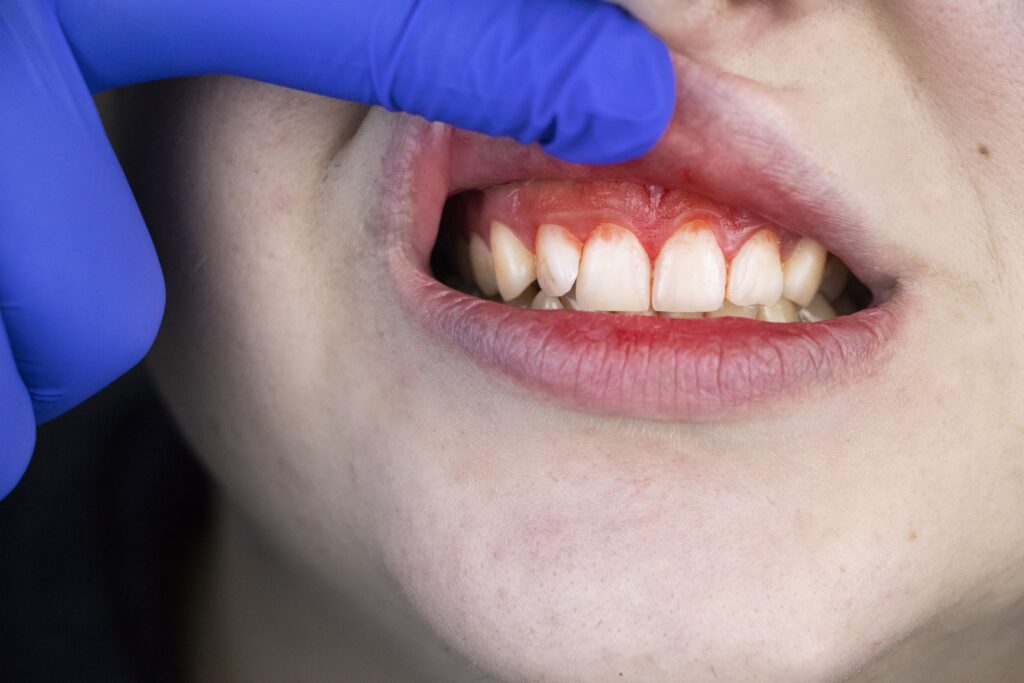 What Deficiency Causes Bleeding Gums
