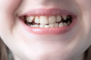 signs your child may need braces