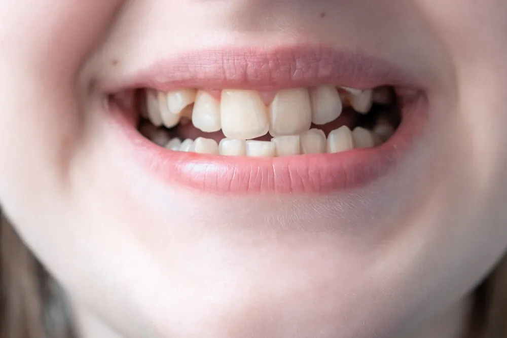 signs your child may need braces